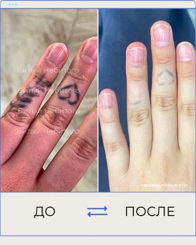 Удаление татуировки